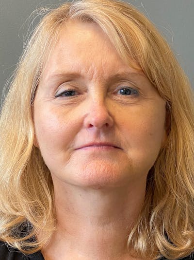 Deep Plane Facelift Before & After Gallery - Patient 175323 - Image 2
