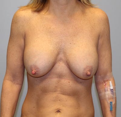 Corrective Breast Procedures Before & After Gallery - Patient 139786 - Image 1