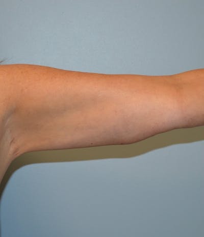Arm Lift (Scarless Arm Lift) Before & After Gallery - Patient 486691 - Image 1