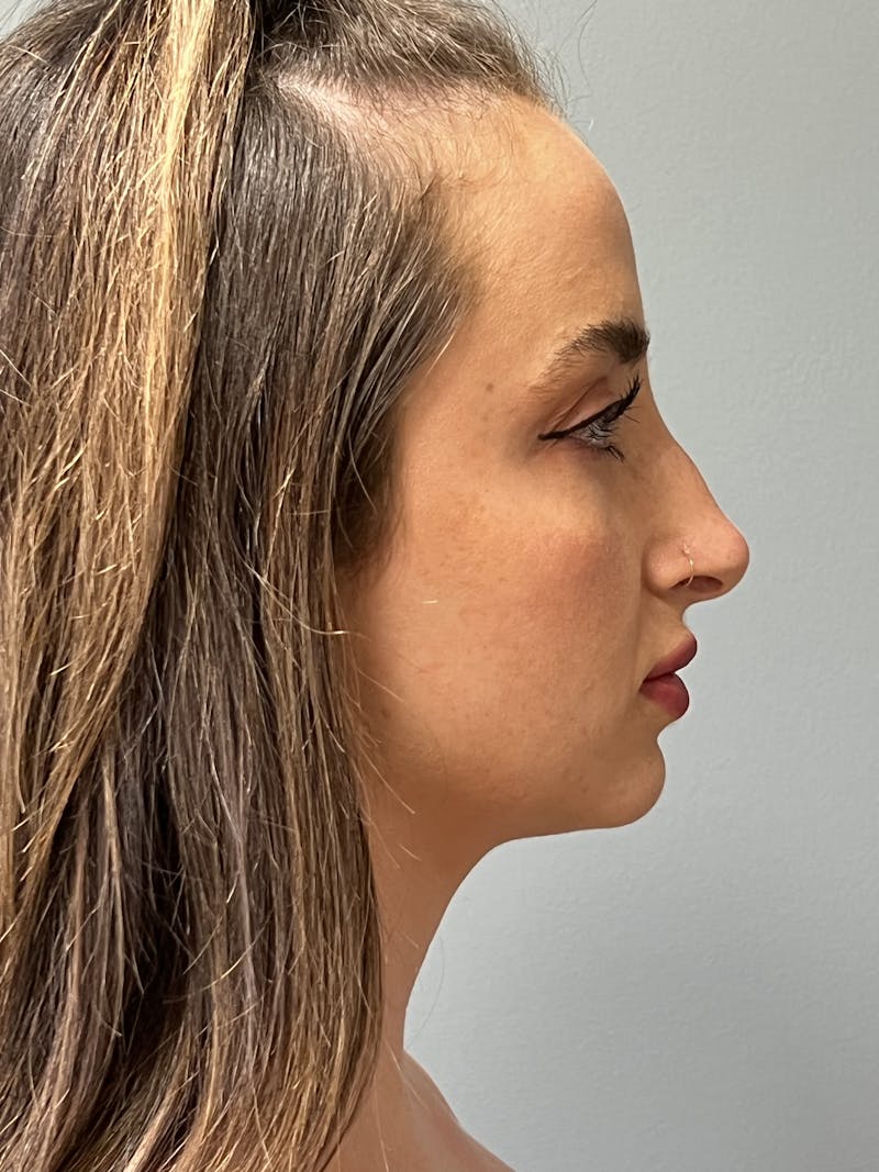 Deep Plane Neck Lift Before & After Gallery - Patient 332328 - Image 5
