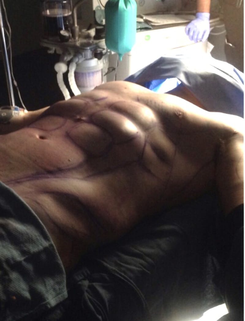 High Definition Men Before & After Gallery - Patient 304271 - Image 4