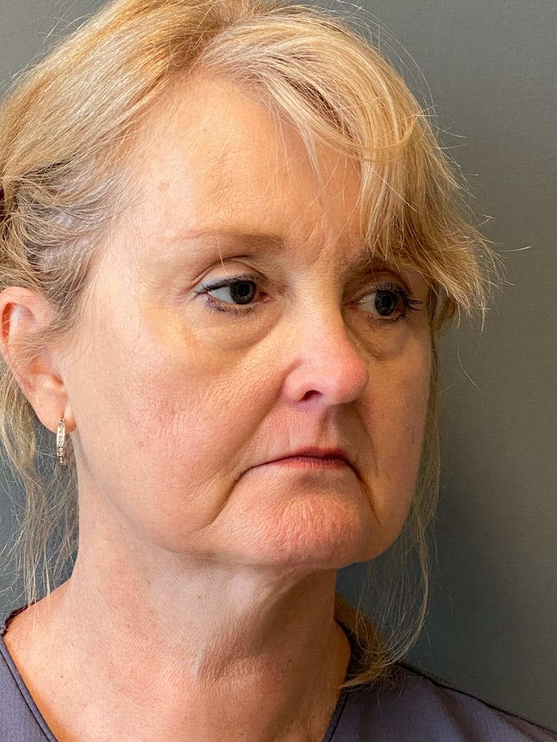 Deep Plane Facelift Before & After Gallery - Patient 175323 - Image 3