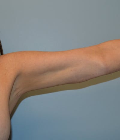 Arm Lift (Scarless Arm Lift) Before & After Gallery - Patient 486691 - Image 2