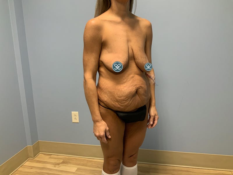 High Definition Mommy Makeover Before & After Gallery - Patient 376105 - Image 5