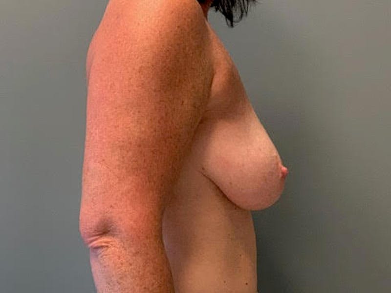 Breast Lift Before & After Gallery - Patient 160014 - Image 5
