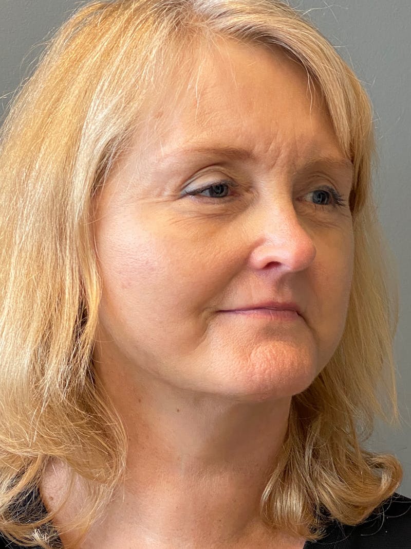 Deep Plane Facelift Before & After Gallery - Patient 175323 - Image 4