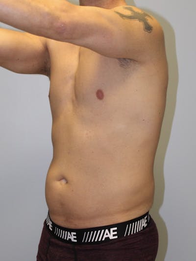 High Definition Men Before & After Gallery - Patient 565620 - Image 1