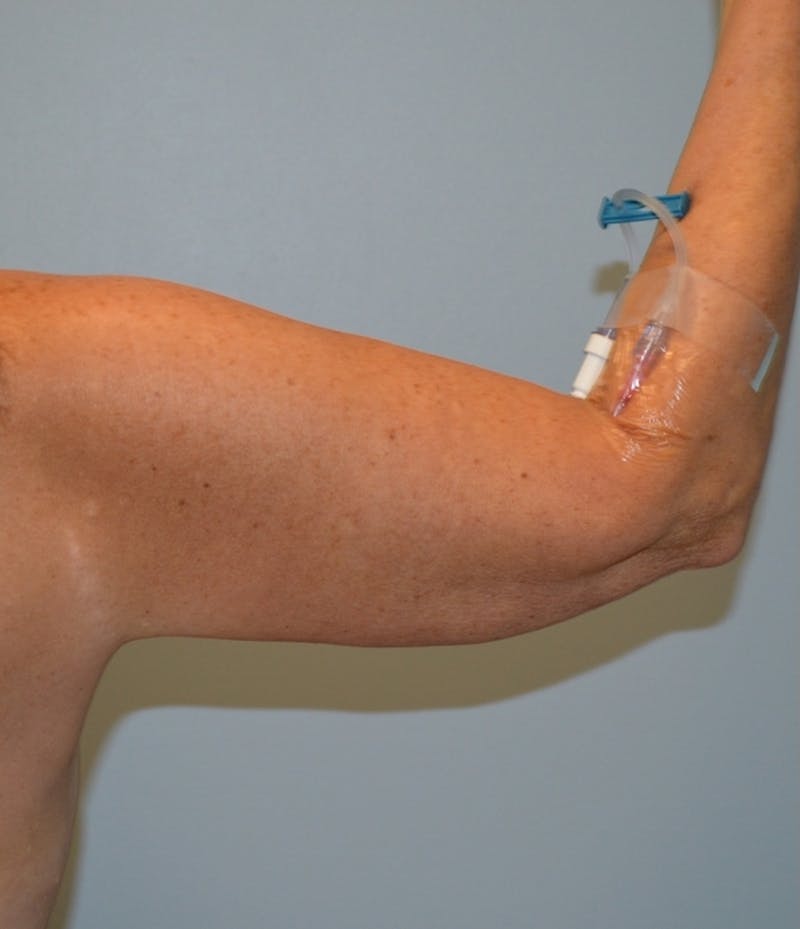 Arm Lift (Scarless Arm Lift) Before & After Gallery - Patient 486691 - Image 3