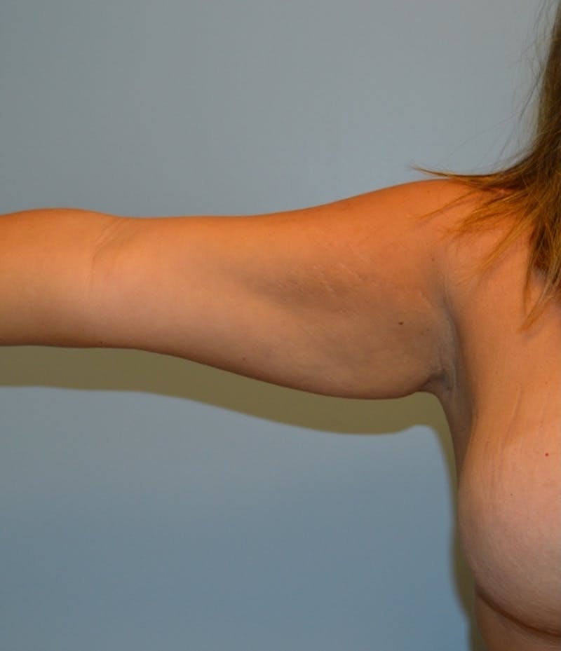 BodyTite (Scarless Skin Tightening) Before & After Gallery - Patient 994011 - Image 1