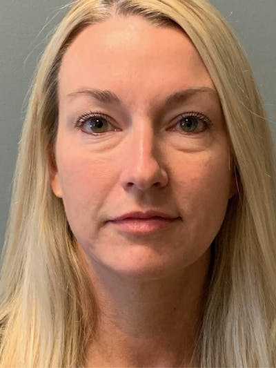 Fat Transfer Before & After Gallery - Patient 210609 - Image 1