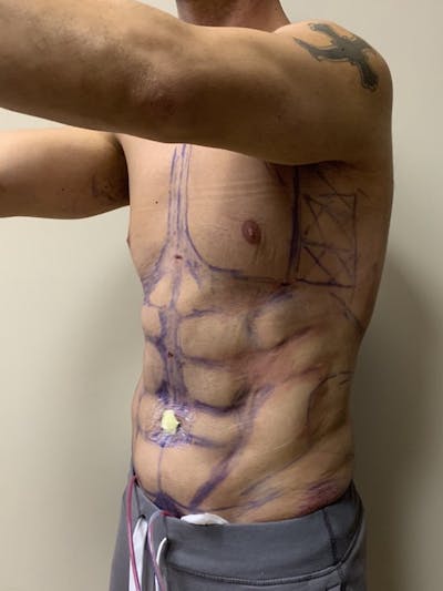High Definition Men Before & After Gallery - Patient 565620 - Image 2