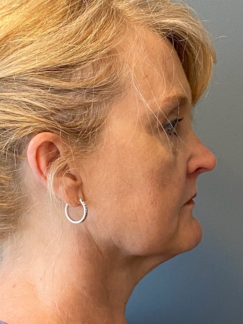Deep Plane Facelift Before & After Gallery - Patient 175323 - Image 5