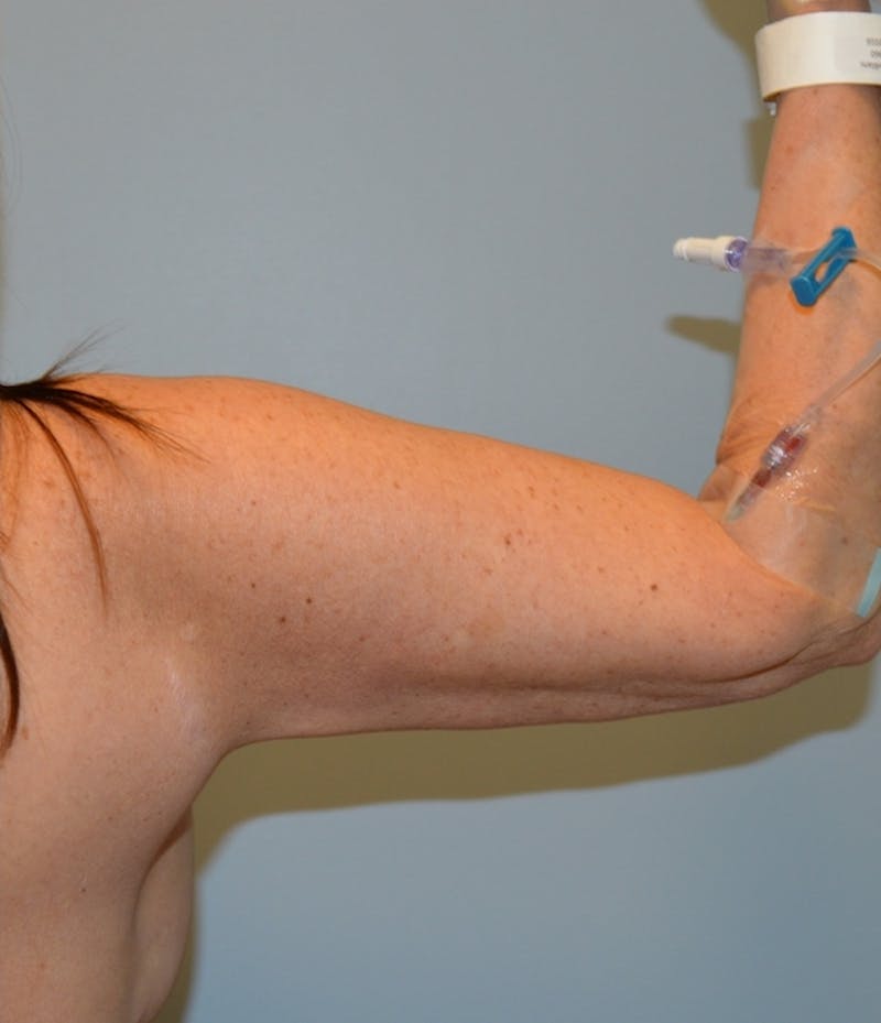 Arm Lift (Scarless Arm Lift) Before & After Gallery - Patient 486691 - Image 4