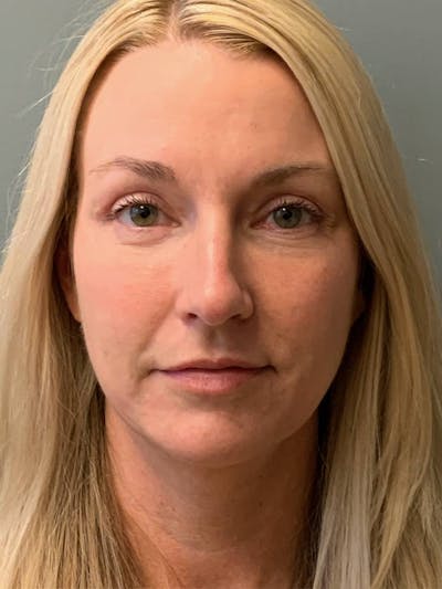 Fat Transfer Before & After Gallery - Patient 210609 - Image 2