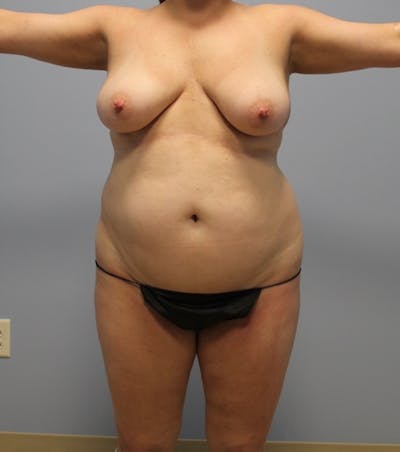 Tummy Tuck Before & After Gallery - Patient 337239 - Image 1