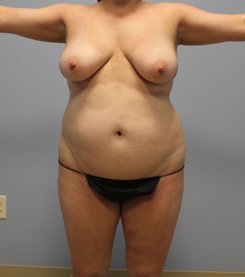 Tummy Tuck Before & After Gallery - Patient 337239 - Image 1