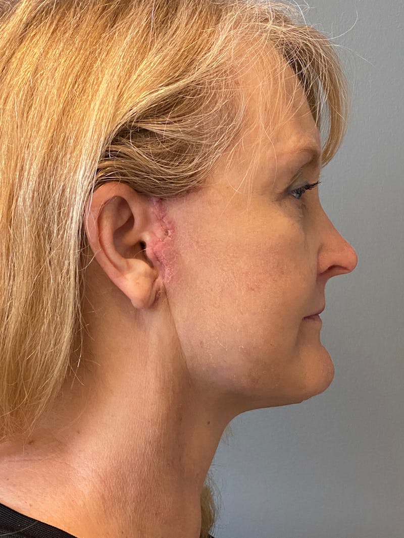 Deep Plane Facelift Before & After Gallery - Patient 175323 - Image 6