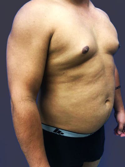 High Definition Men Before & After Gallery - Patient 845606 - Image 1