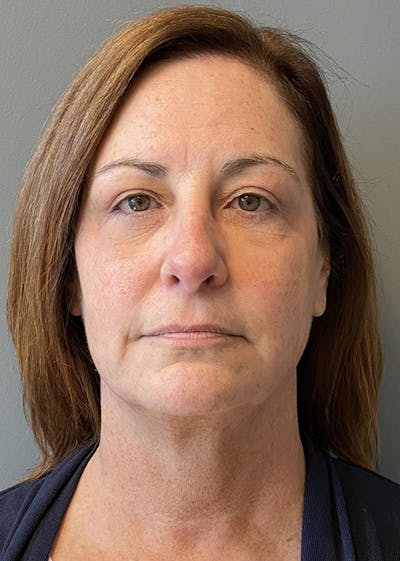 Facial Rejuvenation Before & After Gallery - Patient 350014 - Image 1