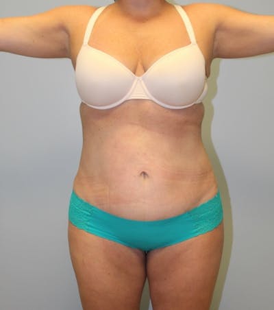 Tummy Tuck Before & After Gallery - Patient 337239 - Image 2