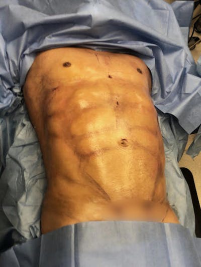 High Definition Men Before & After Gallery - Patient 845606 - Image 2