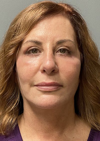Facial Rejuvenation Before & After Gallery - Patient 350014 - Image 2