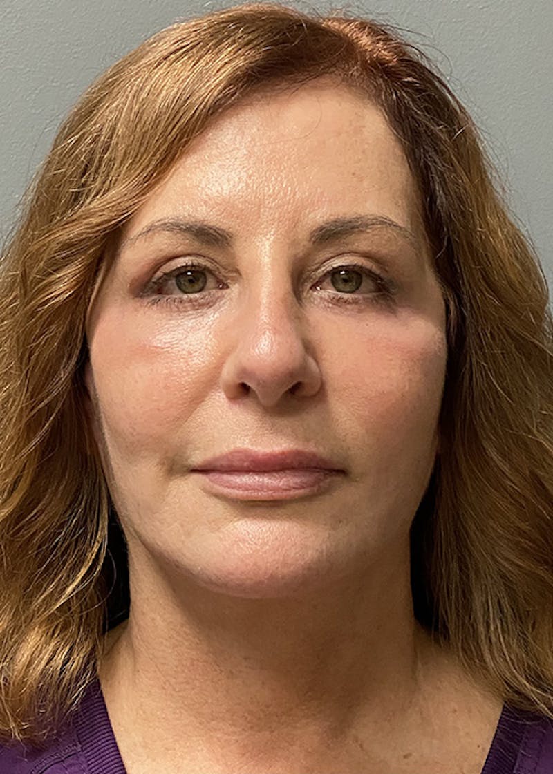 Facial Rejuvenation Before & After Gallery - Patient 350014 - Image 2