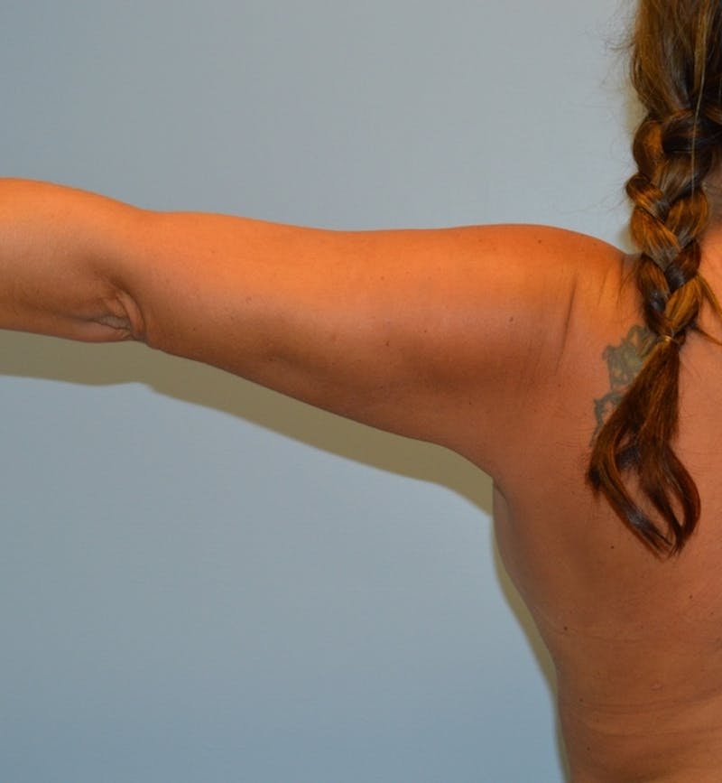 BodyTite (Scarless Skin Tightening) Before & After Gallery - Patient 994011 - Image 4