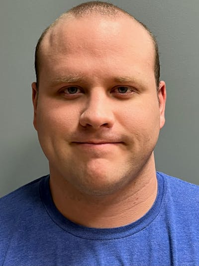 Neck Lift Before & After Gallery - Patient 249324 - Image 1