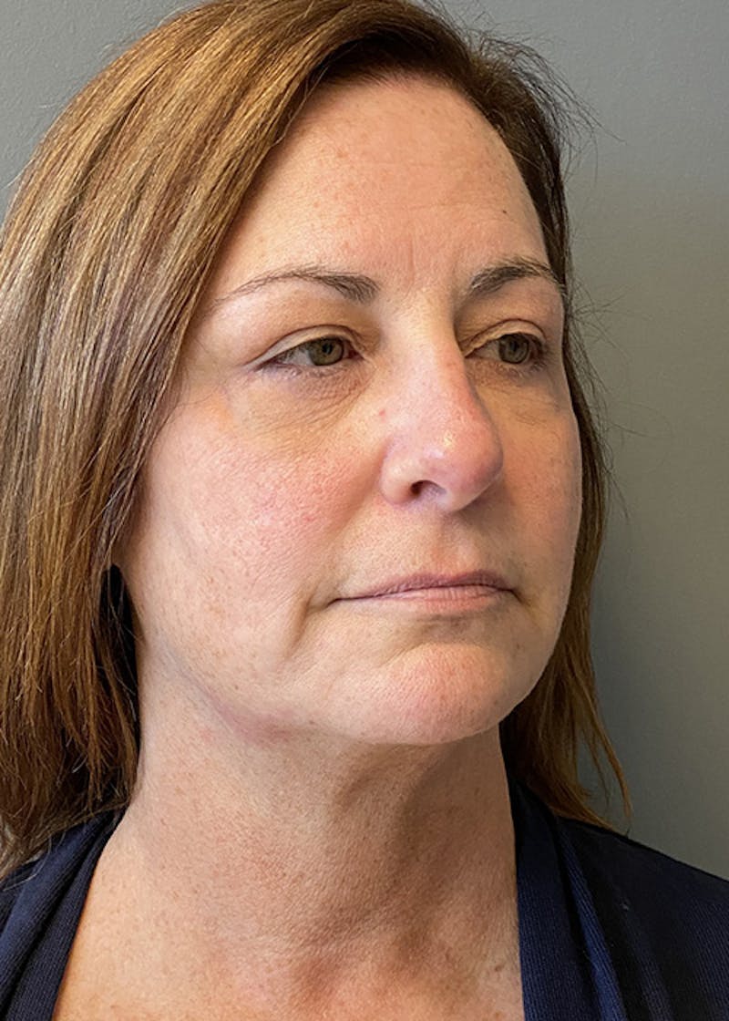 Facial Rejuvenation Before & After Gallery - Patient 350014 - Image 3