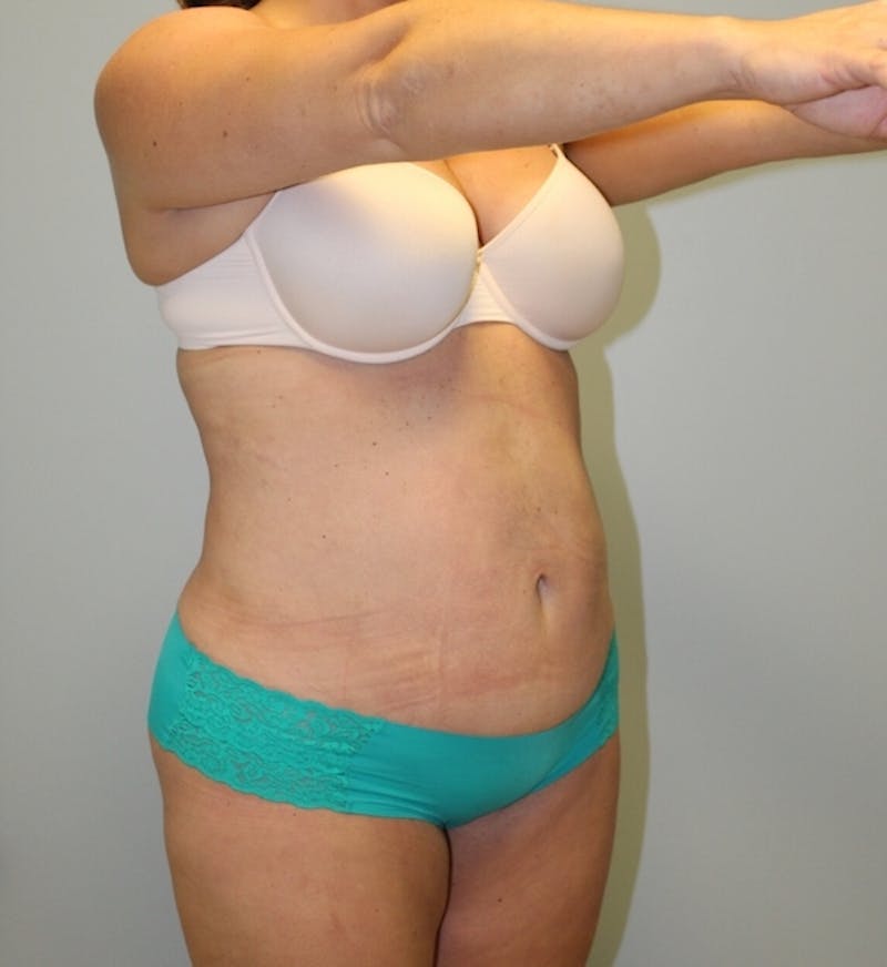 Tummy Tuck Before & After Gallery - Patient 337239 - Image 4