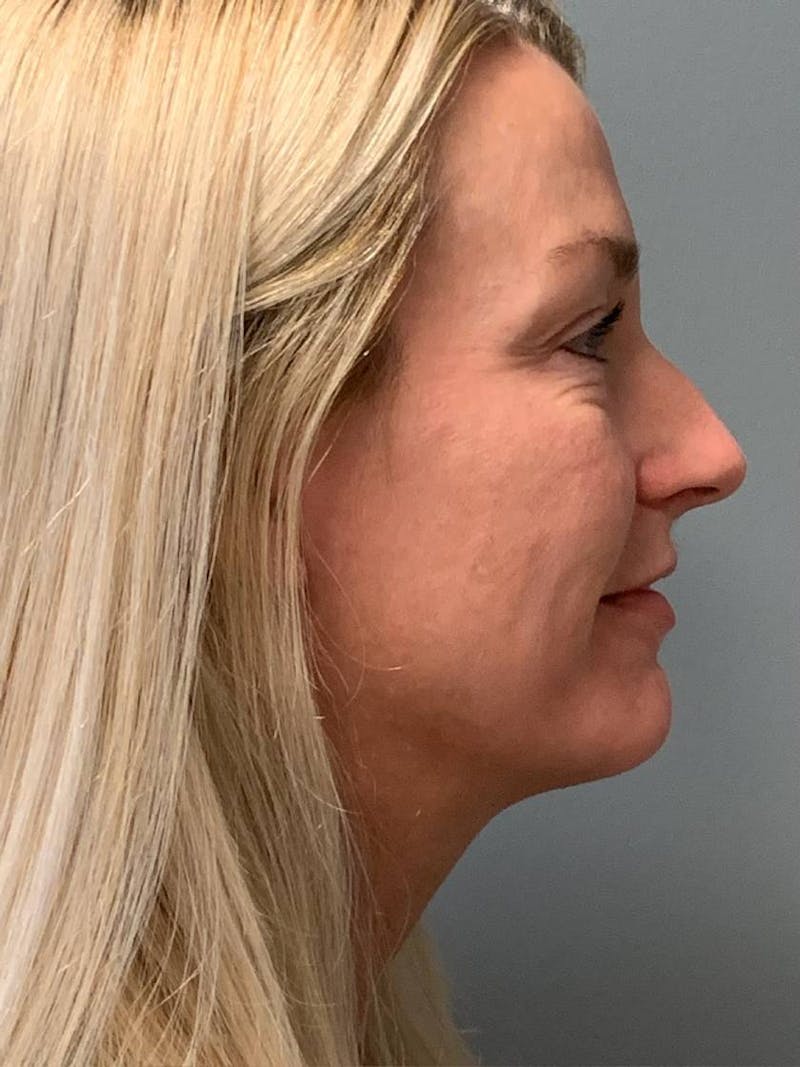 Fat Transfer Before & After Gallery - Patient 210609 - Image 5