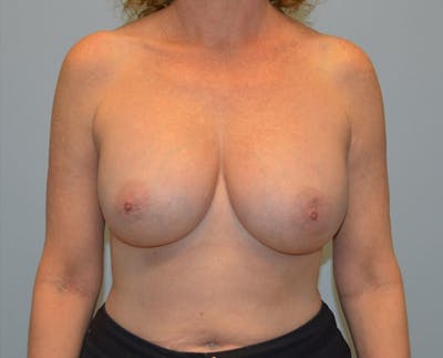 Corrective Breast Procedures Before & After Gallery - Patient 286090 - Image 2