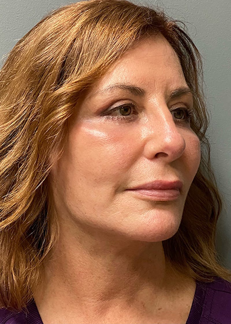 Facial Rejuvenation Before & After Gallery - Patient 350014 - Image 4