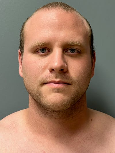 Neck Lift Before & After Gallery - Patient 249324 - Image 2