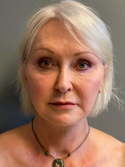 Deep Plane Facelift Before & After Gallery - Patient 234803 - Image 2