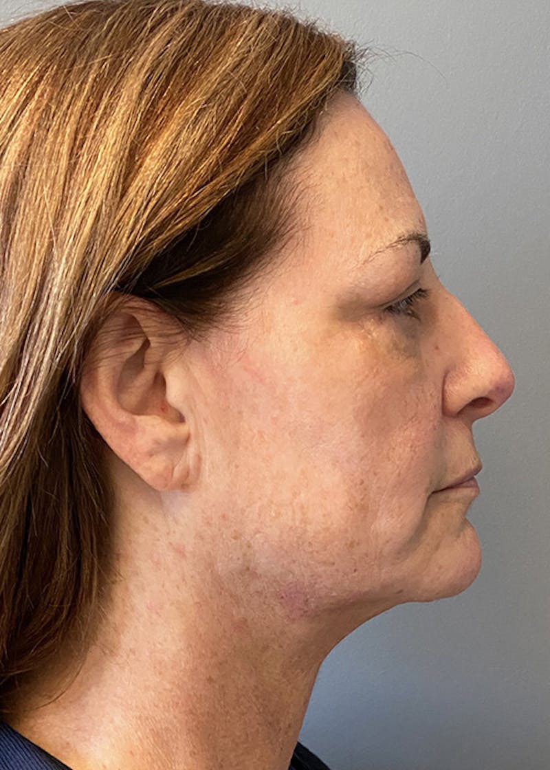 Facial Rejuvenation Before & After Gallery - Patient 350014 - Image 5