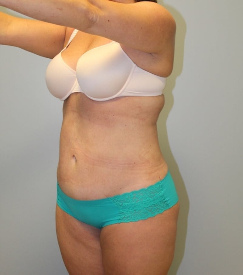 Tummy Tuck Before & After Gallery - Patient 337239 - Image 6