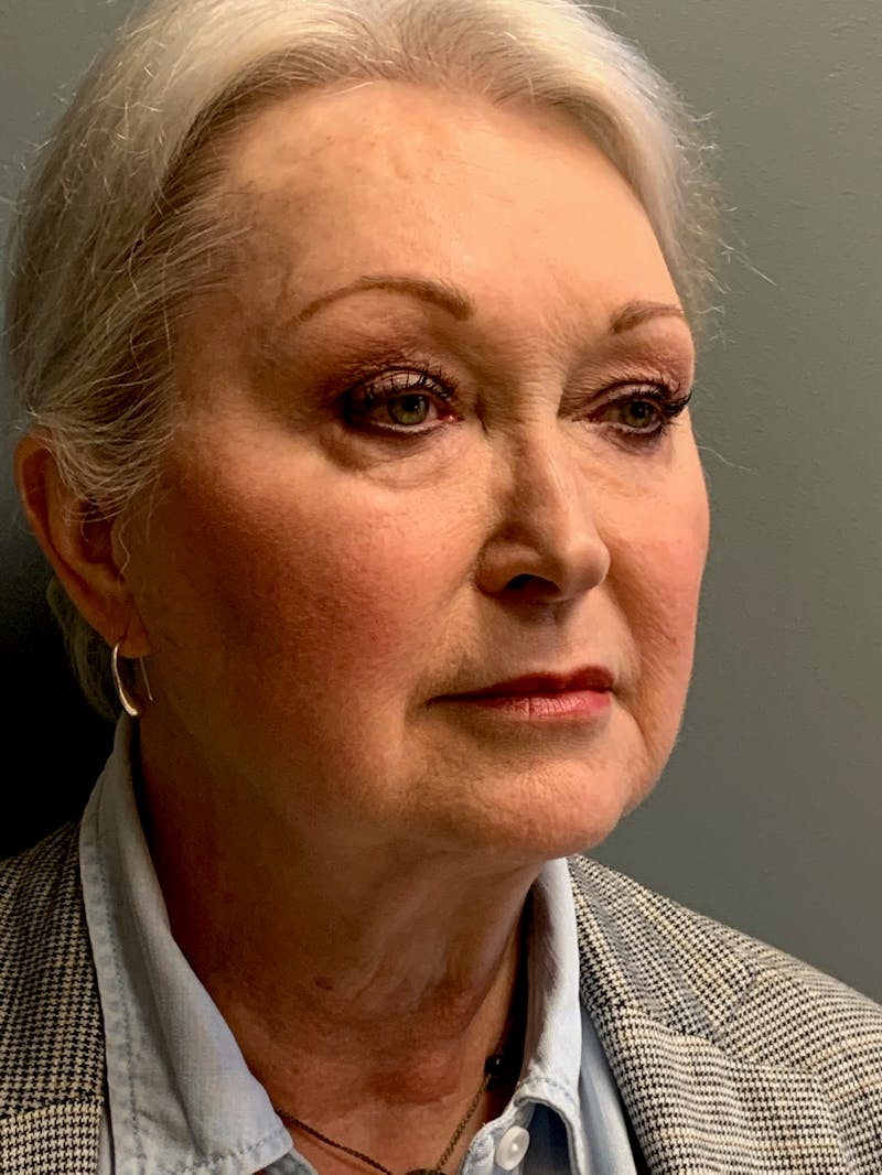 Deep Plane Facelift Before & After Gallery - Patient 234803 - Image 3