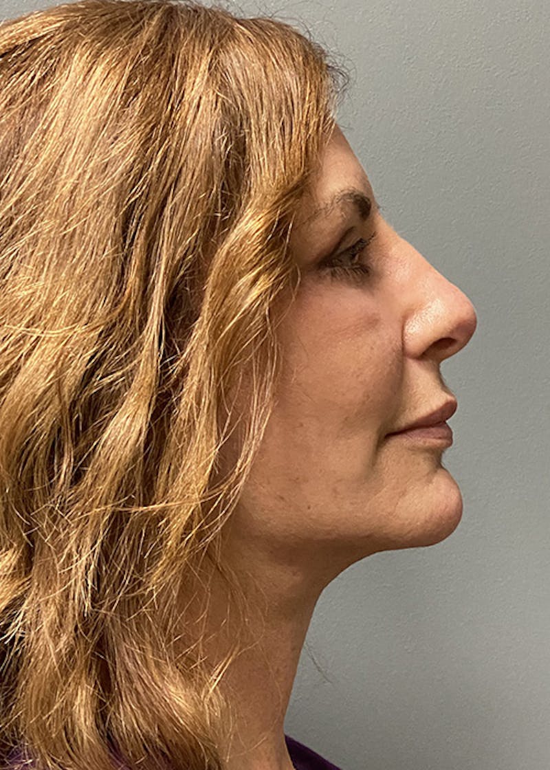 Facial Rejuvenation Before & After Gallery - Patient 350014 - Image 6