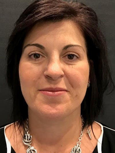 Fat Transfer Before & After Gallery - Patient 249743 - Image 1