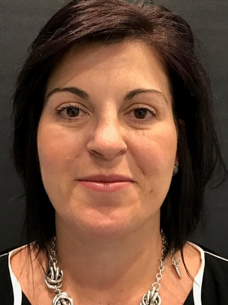 Fat Transfer Before & After Gallery - Patient 249743 - Image 1