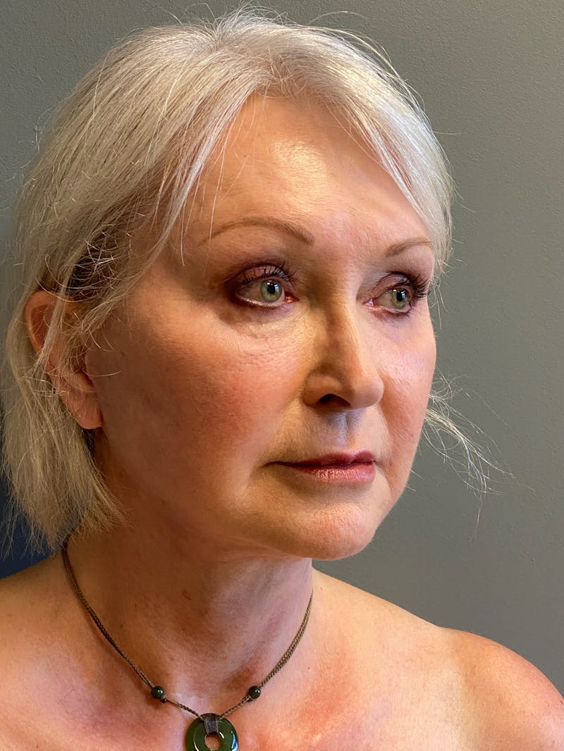 Deep Plane Facelift Before & After Gallery - Patient 234803 - Image 4