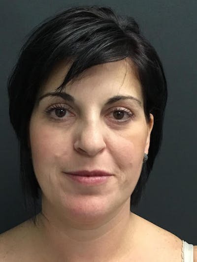 Fat Transfer Before & After Gallery - Patient 249743 - Image 2