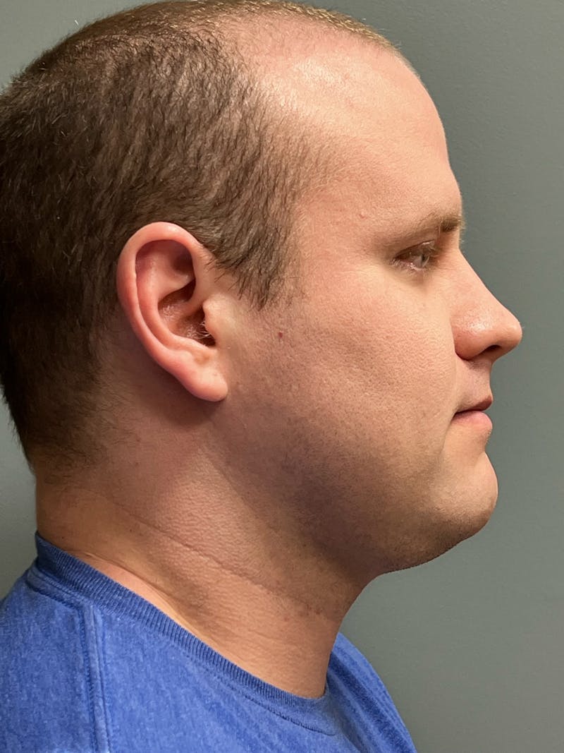 Neck Lift Before & After Gallery - Patient 249324 - Image 5