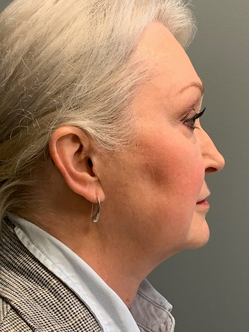 Deep Plane Facelift Before & After Gallery - Patient 234803 - Image 5
