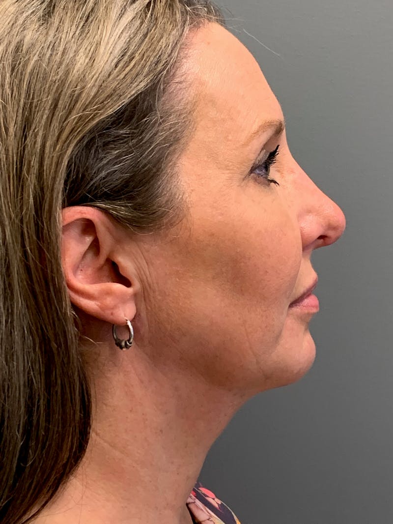 Deep Plane Neck Lift Before & After Gallery - Patient 254041 - Image 6