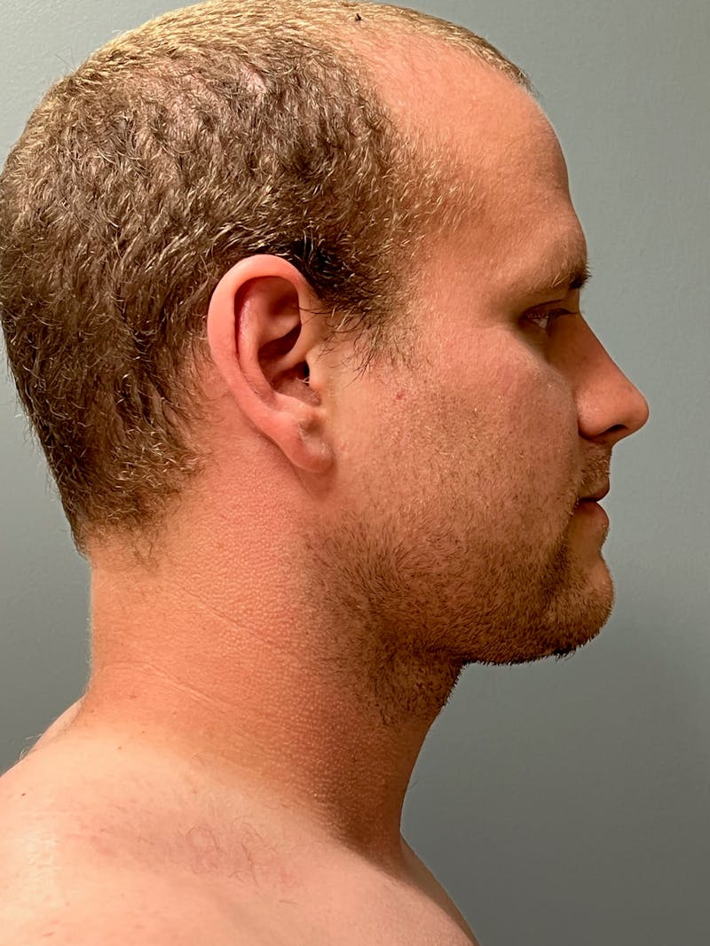 Neck Lift Before & After Gallery - Patient 249324 - Image 6