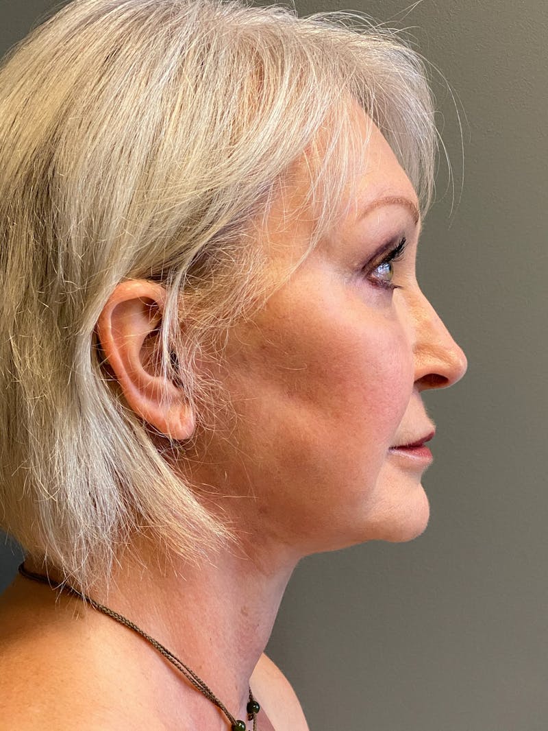 Deep Plane Facelift Before & After Gallery - Patient 234803 - Image 6