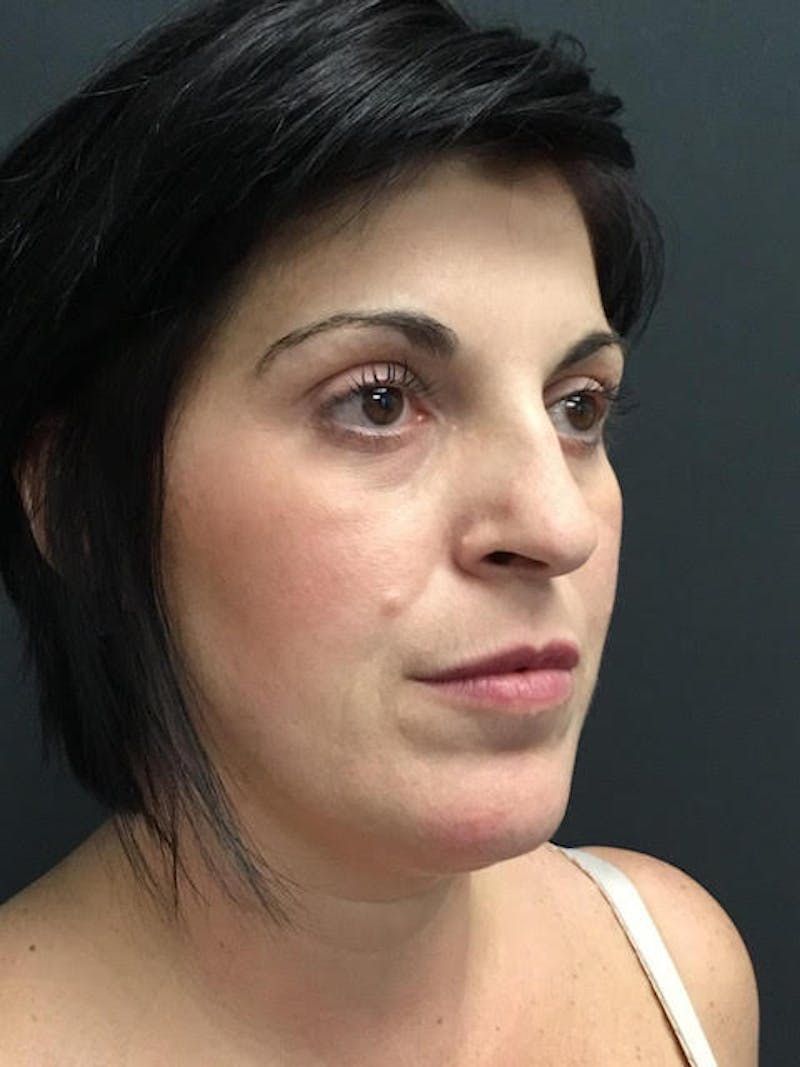 Fat Transfer Before & After Gallery - Patient 249743 - Image 4